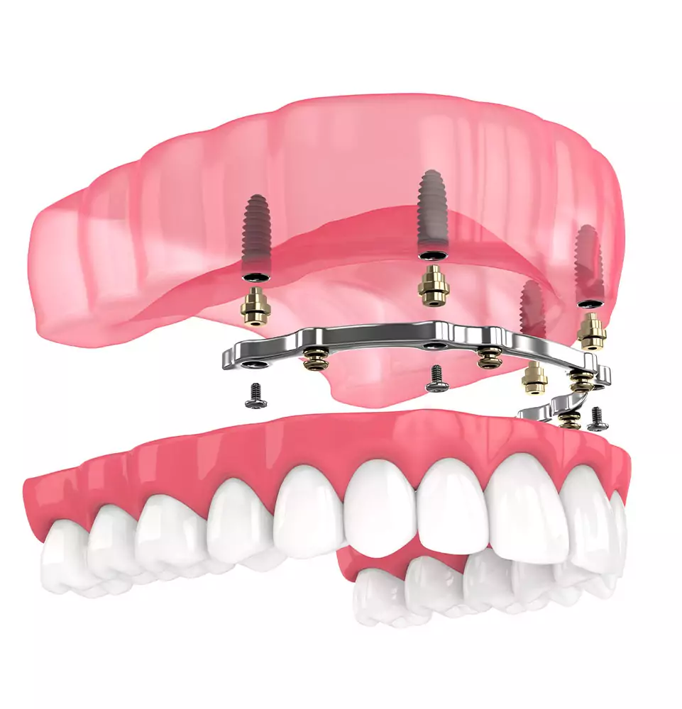3D illustration of an implant-supported full arch restoration with titanium bar and implants